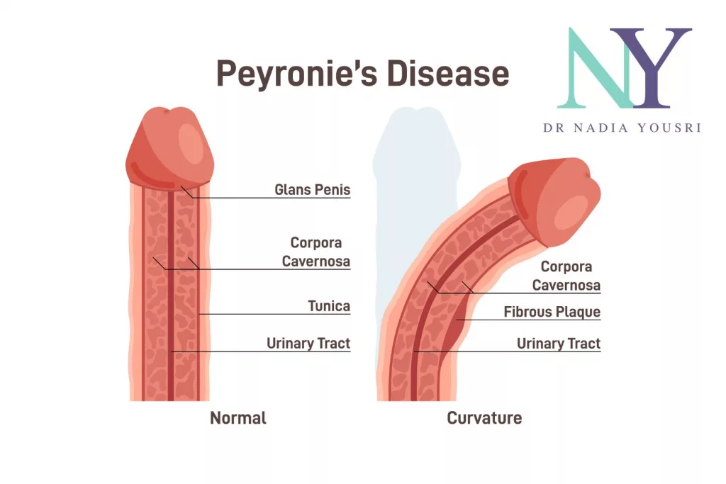 peyronies disease