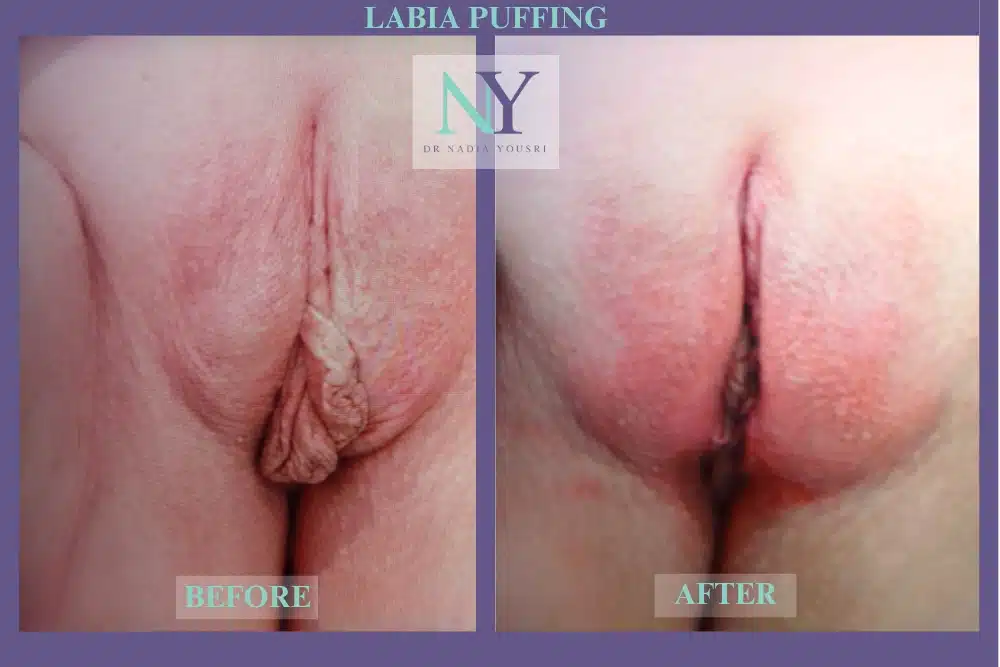 Before and after photos of a Labia Puffing treatment.