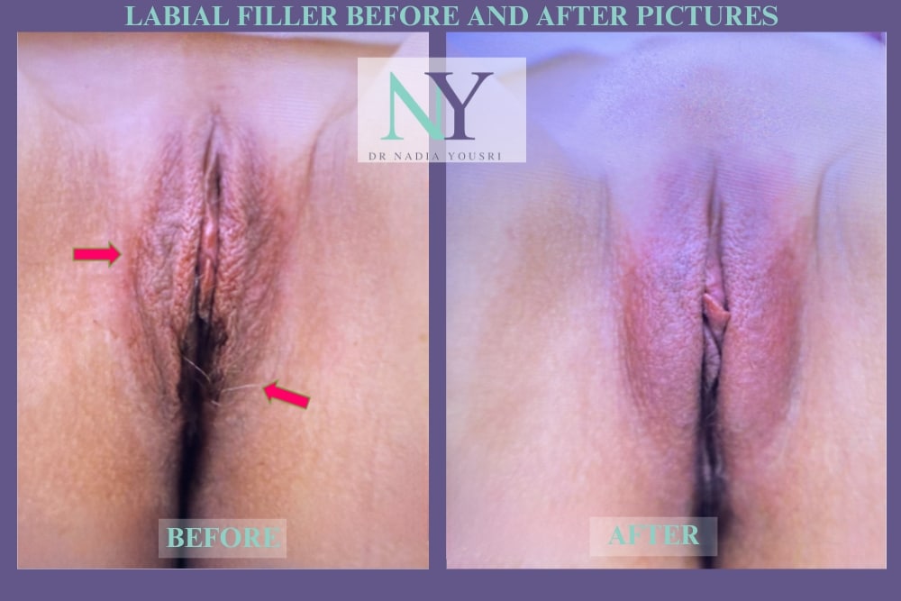 labial filler before and after pictures