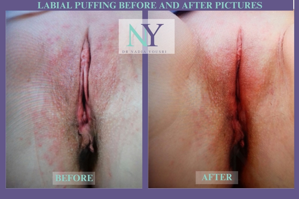 labial puffing before and after pictures
